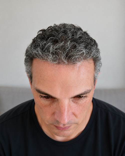 Risultato dopo il trapianto di capelli