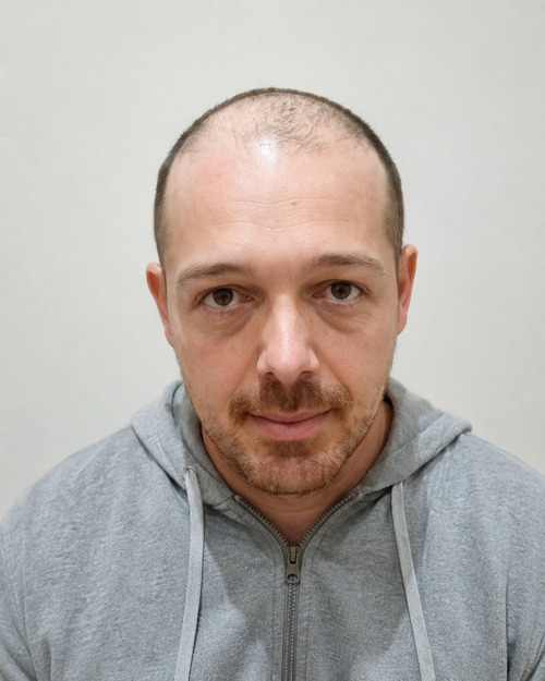 Foto del paziente prima del trapianto di capelli