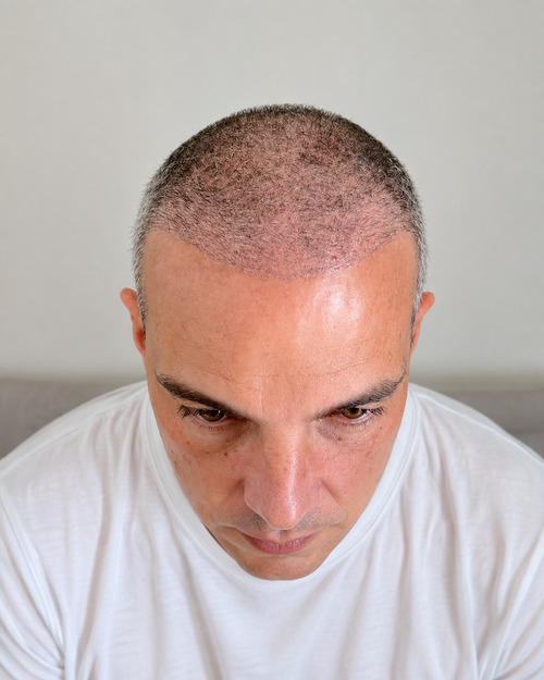 Foto del paziente prima del trapianto di capelli