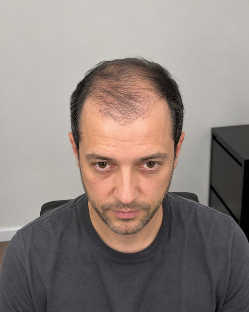 Foto del paziente prima del trapianto di capelli